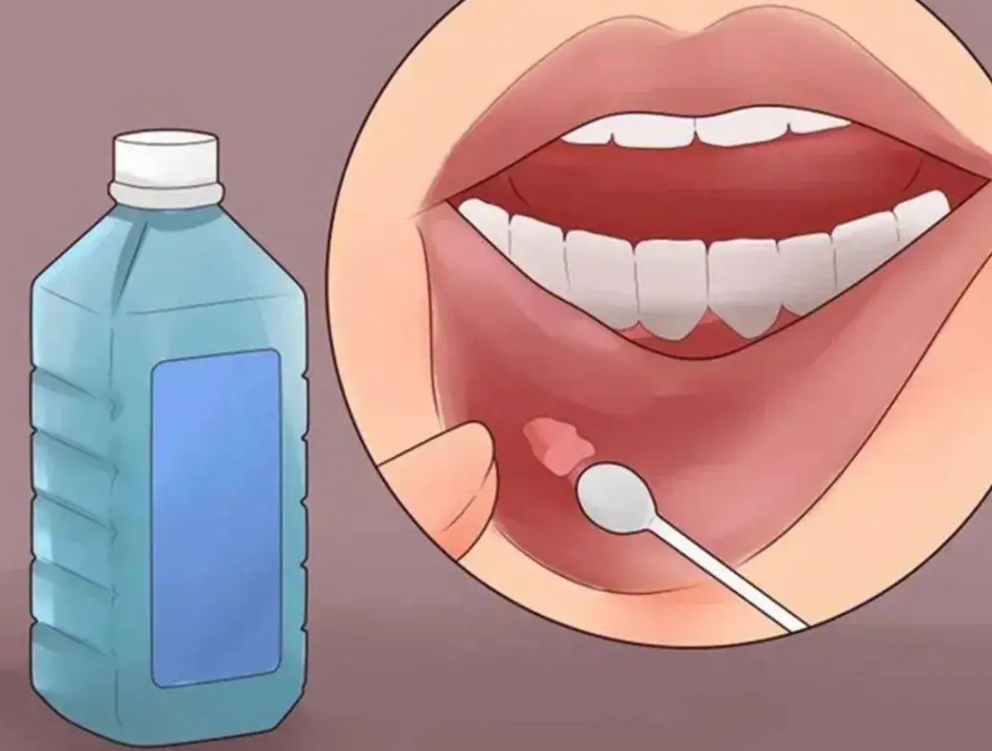 红豆|体内有癌,嘴先知?提醒:口腔出现这5种迹象,可能是癌症在靠近