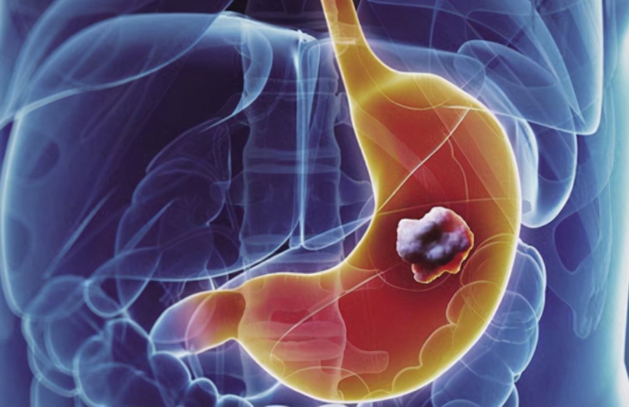 女人胃癌信号图片