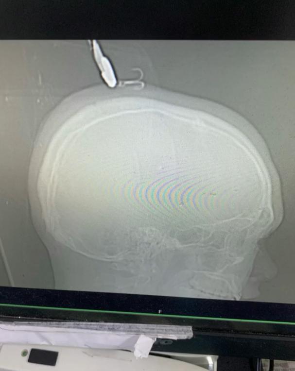 |操作失误，男子钓鱼不小心被鱼钩钩中头，网友调侃：钓鱼要戴头盔