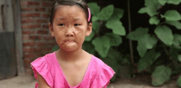 6岁女孩被妈妈夺走一张脸，每天哭求摘下“面具”，医生：作孽