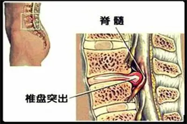 腰椎间盘突出|别再弯腰提重物了，小心腰椎间盘突出症！