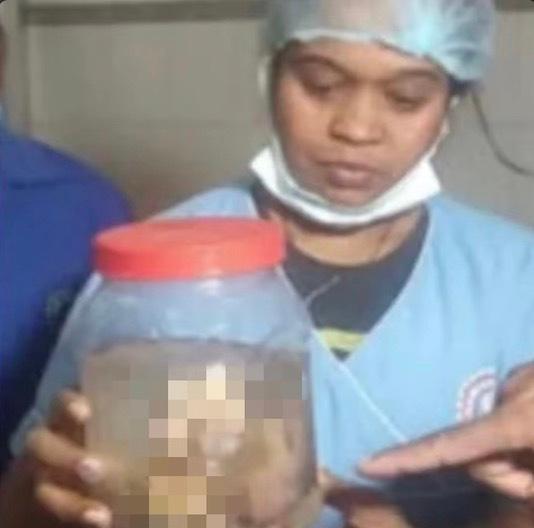 新生女婴肚子奇大,医生竟在她胃里,发现了8个胎中胎!