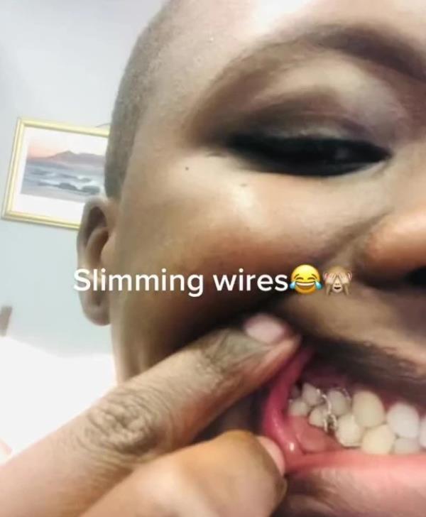 凯特王妃|女子为做缩胸手术疯狂减肥，竟用铜丝“封嘴”，节食减掉14公斤？