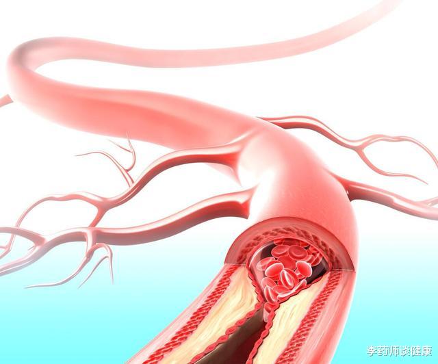 动脉粥样硬化|近2亿国人有颈动脉斑块！记住这4点，或可改善斑块降低脑梗发生率