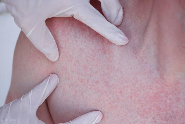 荨麻疹|寻麻疹的注意事项有什么?