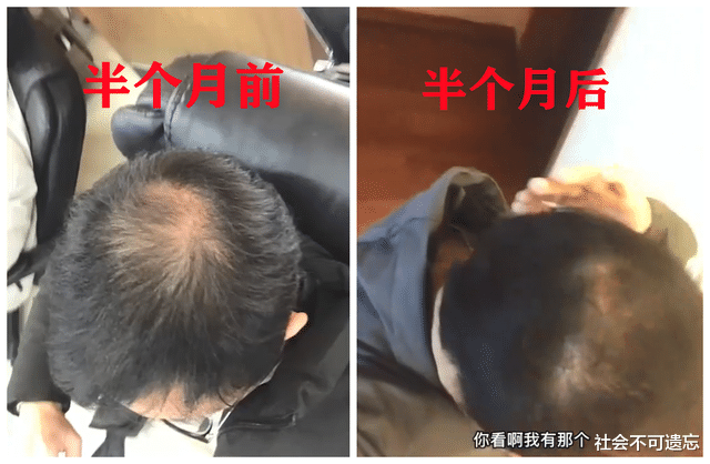小姐姐 新奇！男子秃顶求医无效，半个月不用洗发水竟长出头发：又粗又硬
