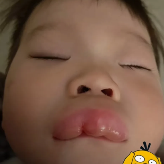 一男子给孩子喂了点混合果泥,万万没想到,半夜的时候孩子嘴巴肿胀跟蜜蜂蛰了一般!