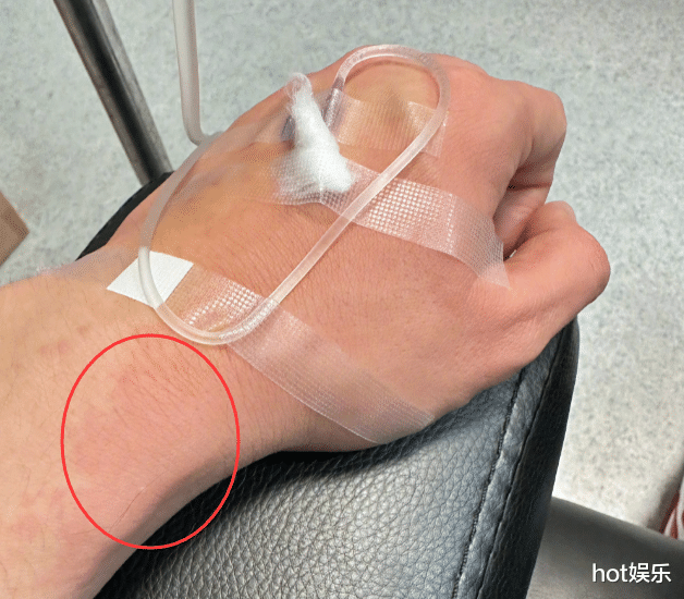 黄晓明|刚喝完喜酒,黄晓明就因肠胃炎入院,手臂全是疙瘩,自嘲不能放纵