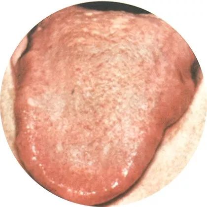 失眠|中医中的舌诊，了解吗