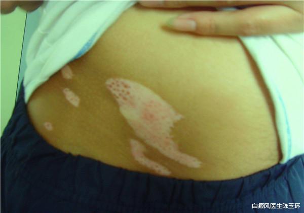 饮食|白癜风秋冬季饮食攻略