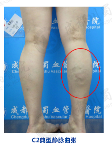 静脉曲张|下肢静脉曲张，要早治！川蜀专家：不要等腿烂了才治，此时久难以根治了！
