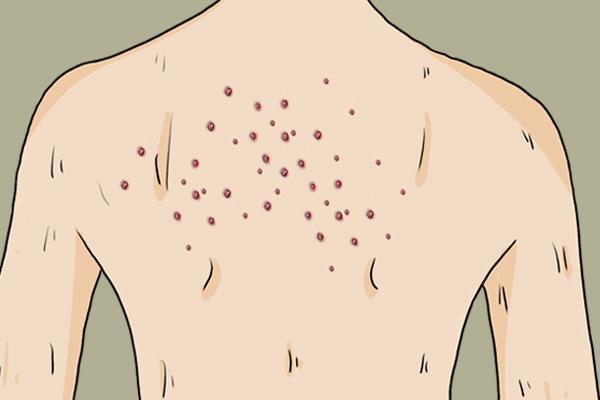 女大学生喉咙长"肉粒",查出hpv,父母怒斥:就是谈恋爱惹的祸