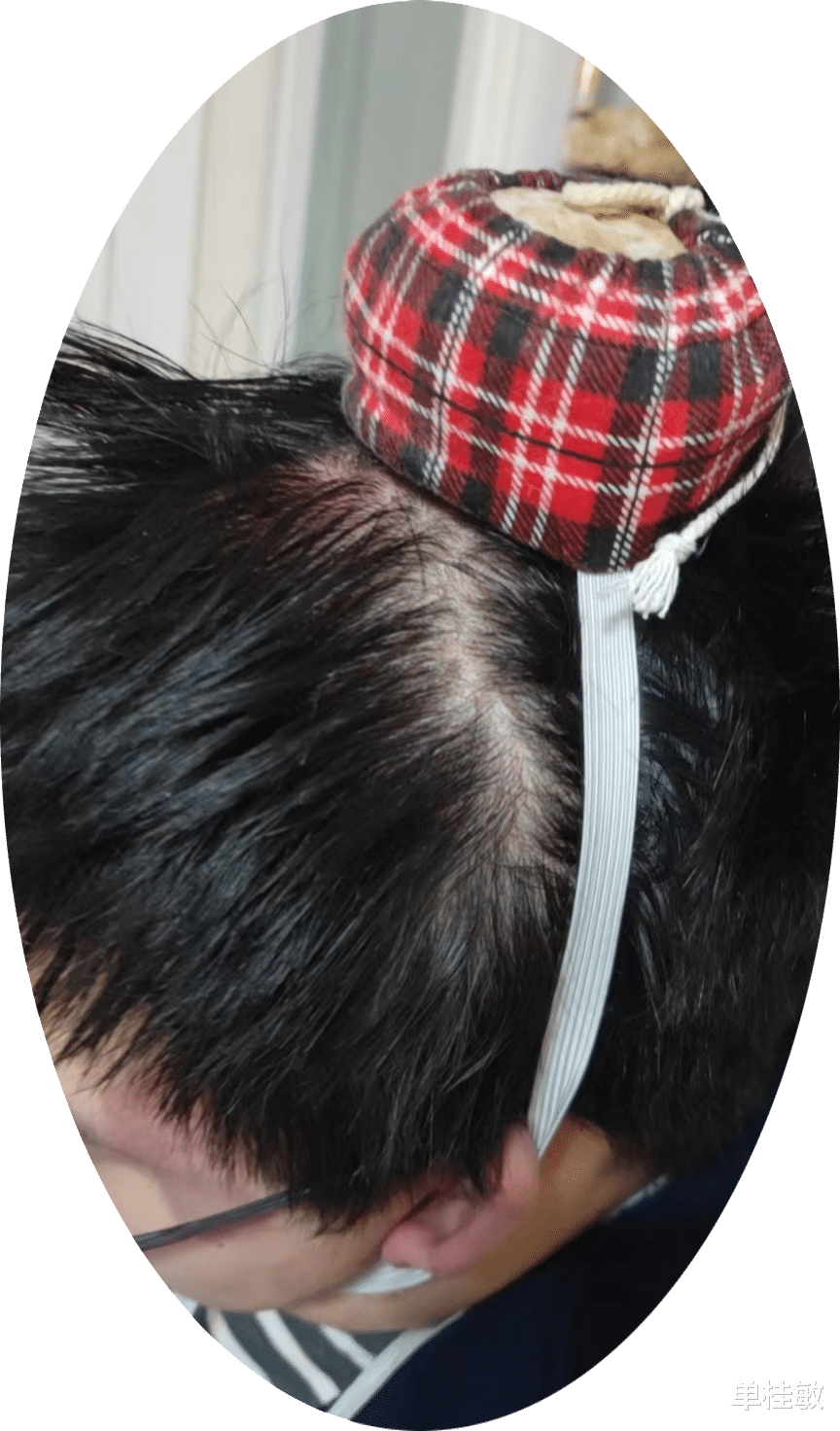 艾灸|你阳了吗阳了艾灸吧