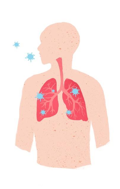 肺炎|新冠病毒感染继发细菌感染，这5种口服抗生素可作为首选