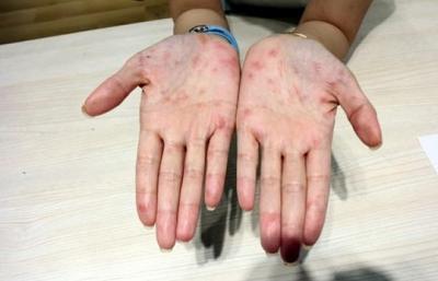 肝脏|肝若不好，手脚可能提前亮起4个“红灯”，早知，早养，早好