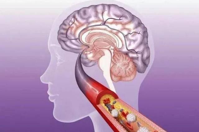 养生|脑梗的源头已发现，肥肉没上榜，第1名大家几乎天天吃