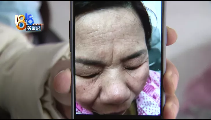 美甲 美甲店里做祛斑,脸部为何红肿痒