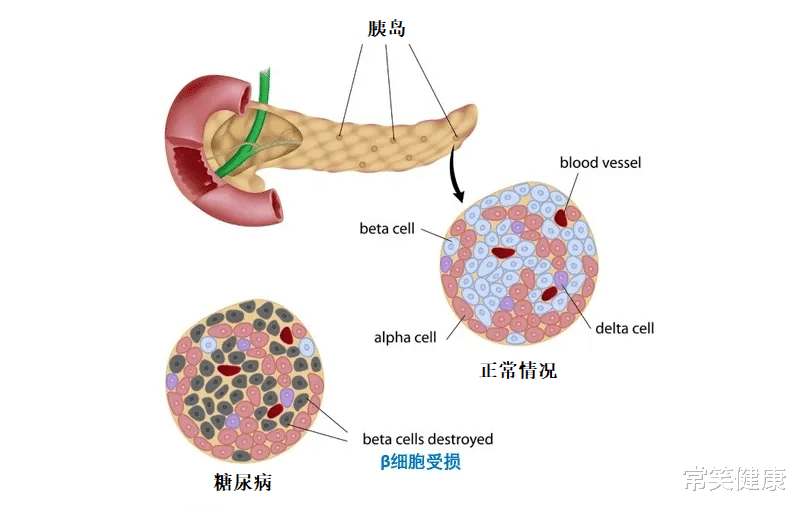 维生素D|胰岛不好,血糖如何能好?这款维生素或能让你的胰岛重获新生!