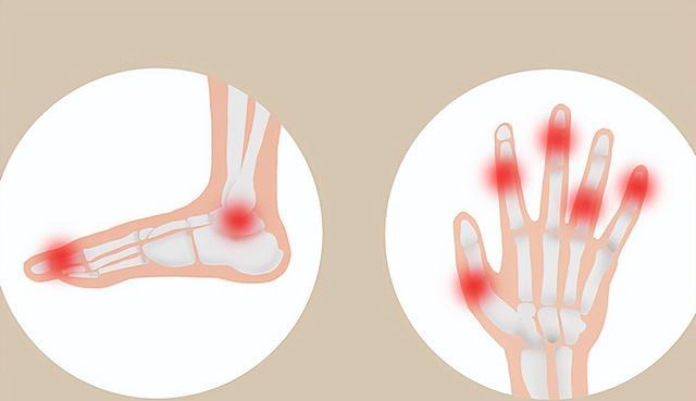 腹泻|痛风不能吃海鲜?别记错了,有3种食物,痛风患者一口都别吃