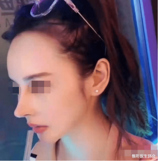 医生|真相了？隆鼻手术做了，就停不下来！就要一直做，一直维护？