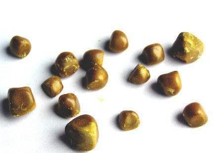 衰老|被肾结石折磨了近十年,痛不欲生,如今排出,分享一下治疗经验!