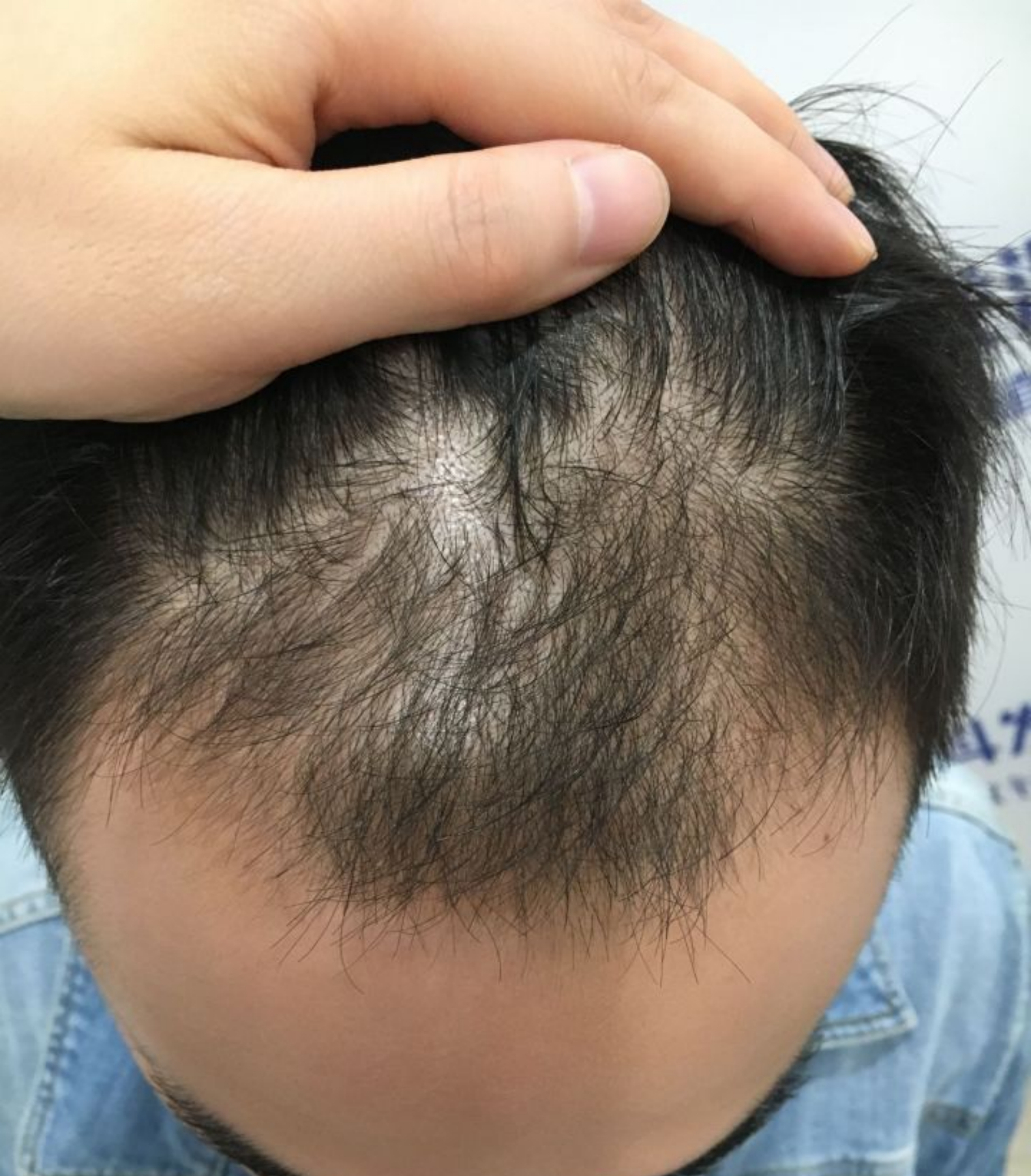 土豆丝|国内公认最强生发液就是牛！短短30天，逆袭发量王者不在话下！