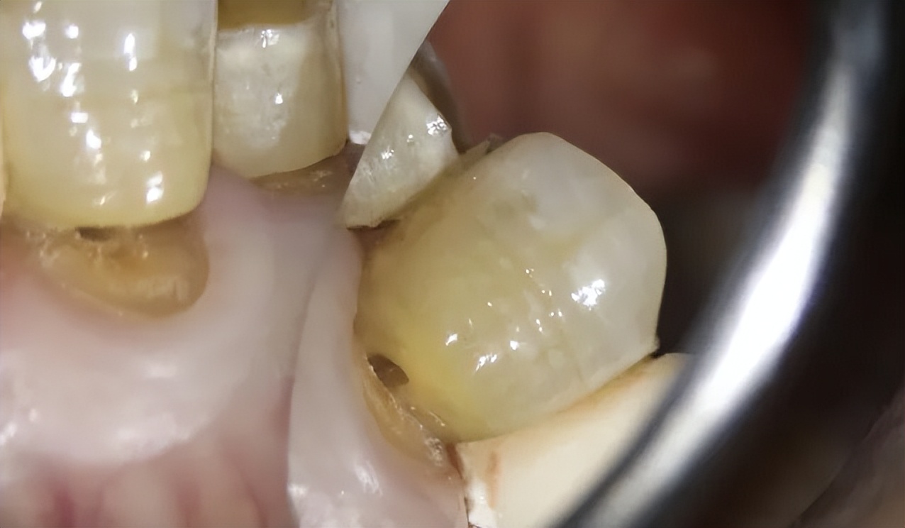 心力衰竭|不要横向刷牙!不要横向刷牙!不要横向刷牙!心脏|布鲁|牛奶