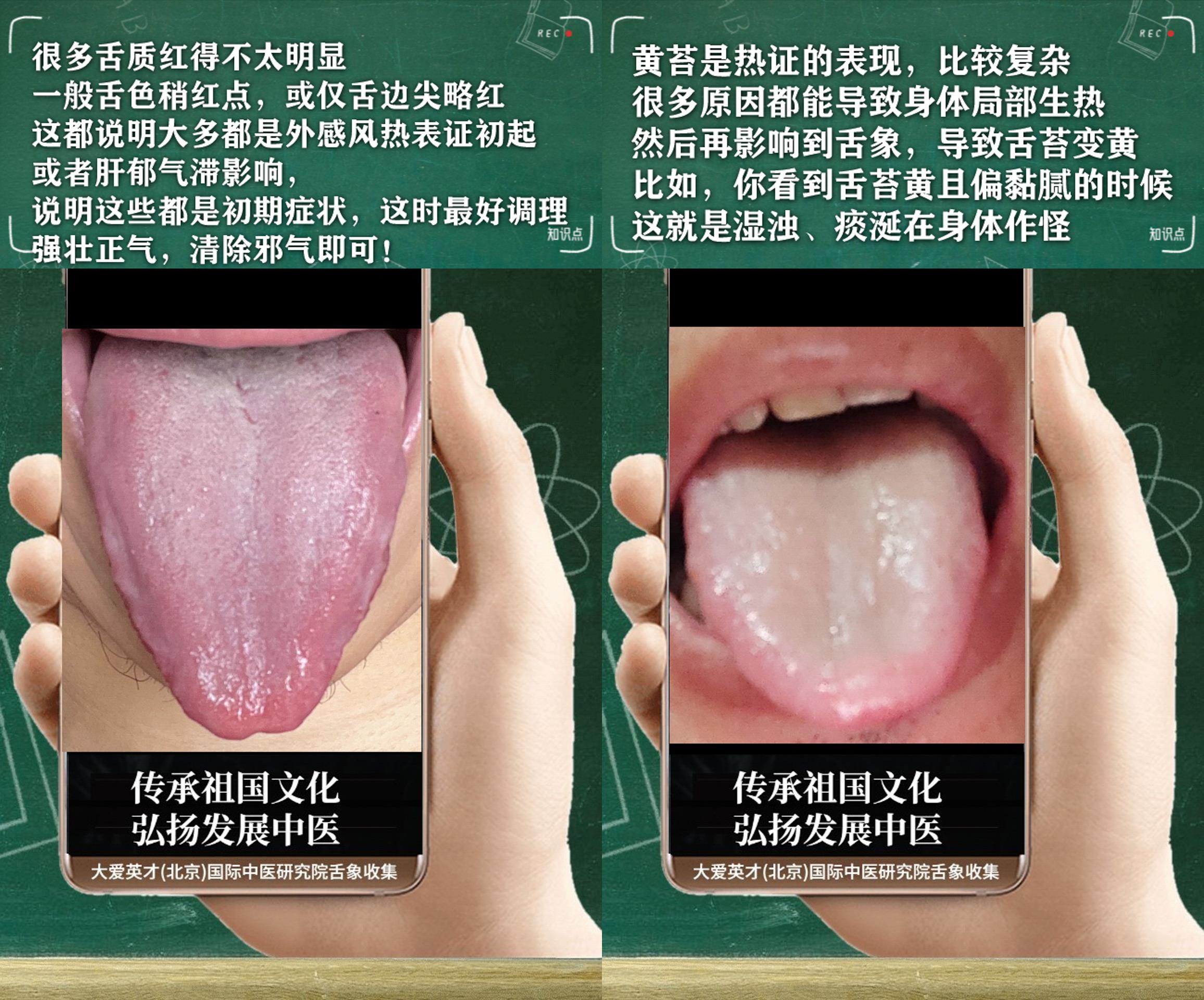 咳嗽|舌诊实例：常紧张、没有精神、经常咳嗽吐痰、一直未愈非常绝望