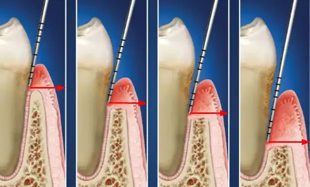 牙齿|芽美口腔:出现了牙周袋,该如何解决呢
