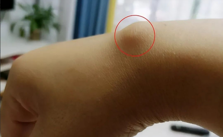 腱鞘炎|30多岁小伙上班敲键盘周末钓鱼,手腕疼痛难忍,一查竟是腱鞘炎