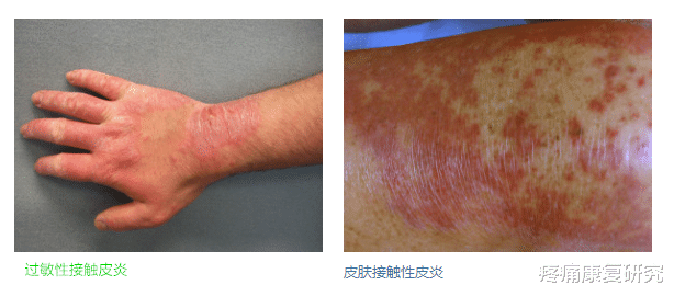 皮炎|皮质类固醇贴剂治疗瘢痕疙瘩和增生性瘢痕