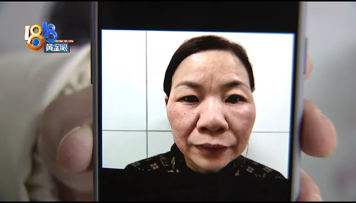 美甲 美甲店里做祛斑,脸部为何红肿痒