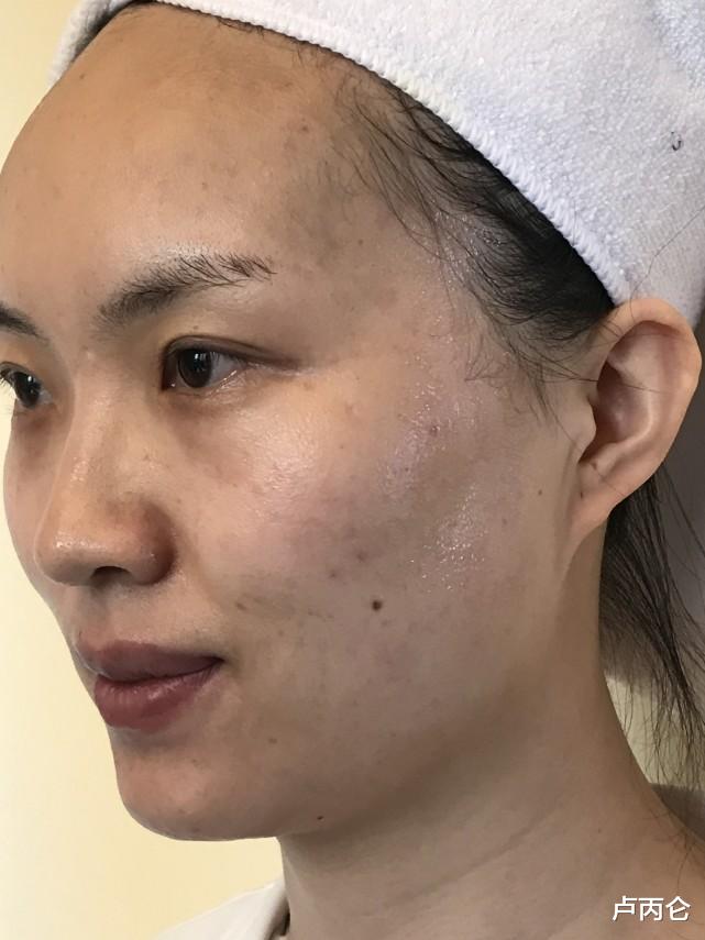 面膜 关于水光针,你想知道的都在这里