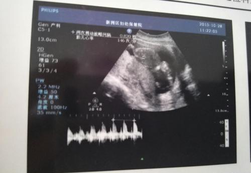 女子“怀孕”3个月,B超显示腹中没有胎儿,孕妇大哭医生却笑了