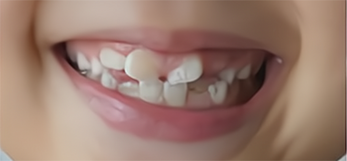 牙齿|成人门牙长歪了怎么办?