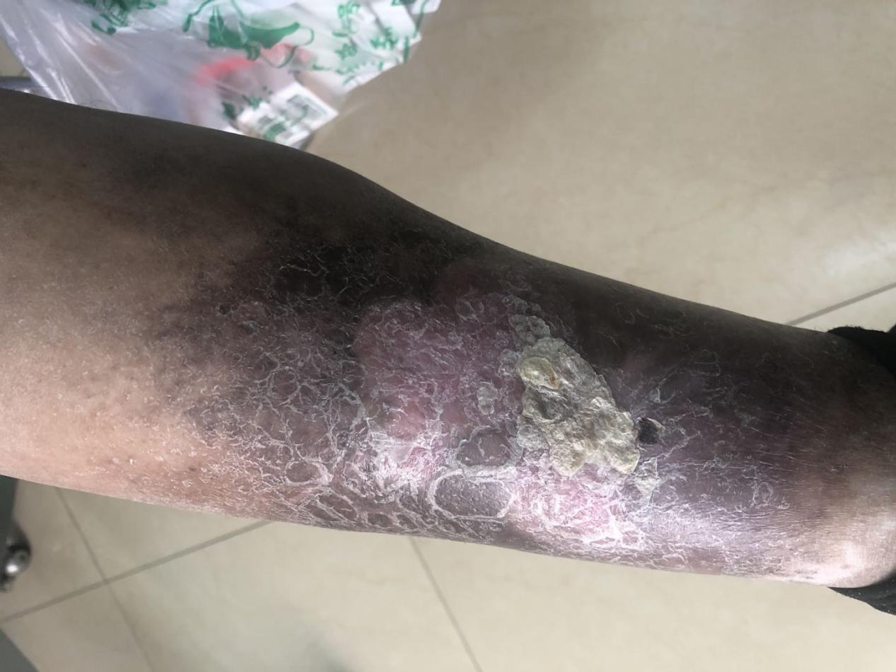 淋巴瘤|「静脉溃疡案例12」误以为老烂腿会传染,妻子被丈夫嫌弃分房十年