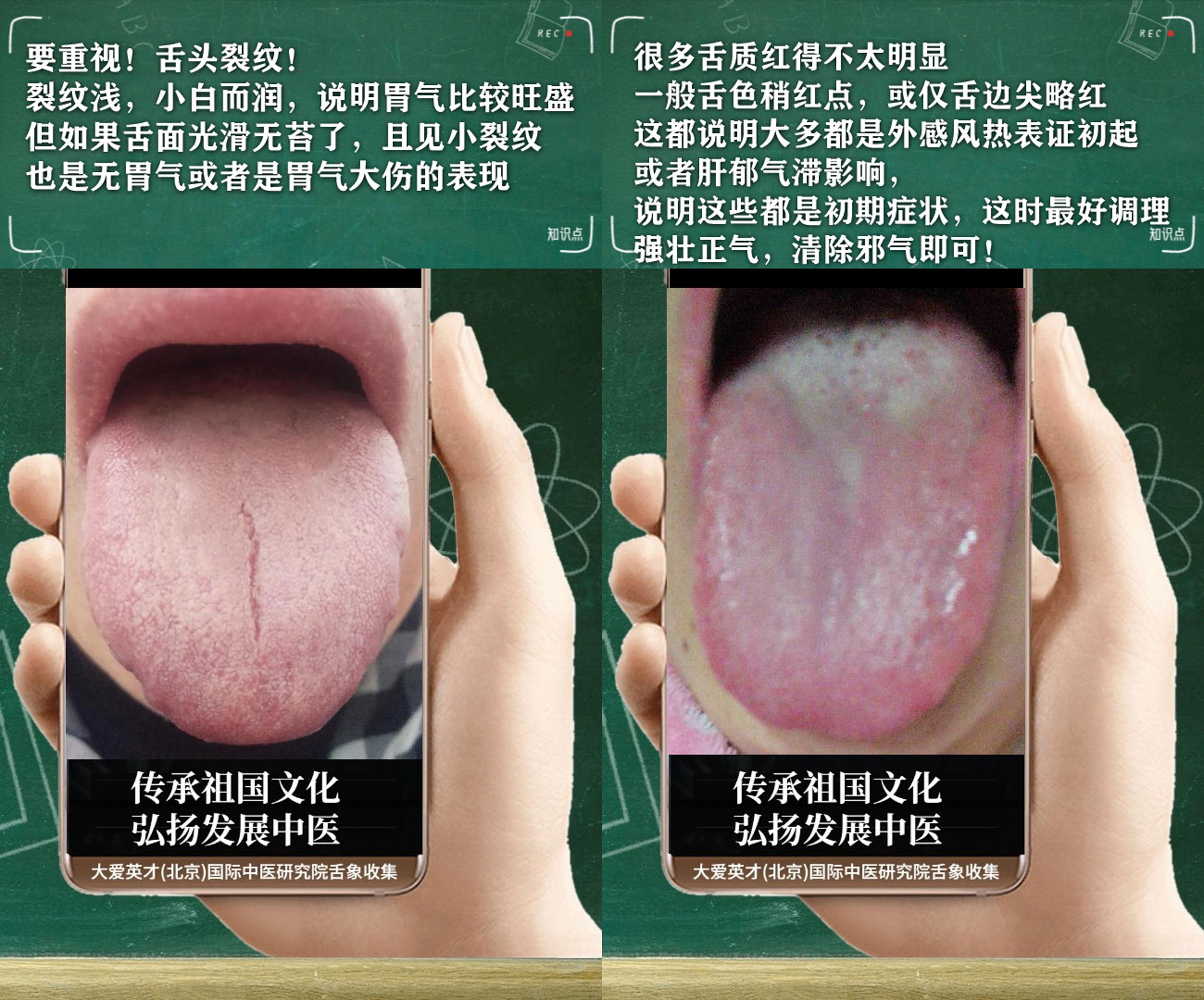 黄芪|中医病案：很抑欲，关节疼痛重，痰热互结，容易反复很不舒服