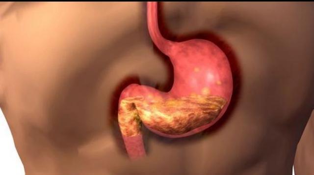 胃病|患了慢性胃病应该注意什么呢？在生活中需注意什么呢？