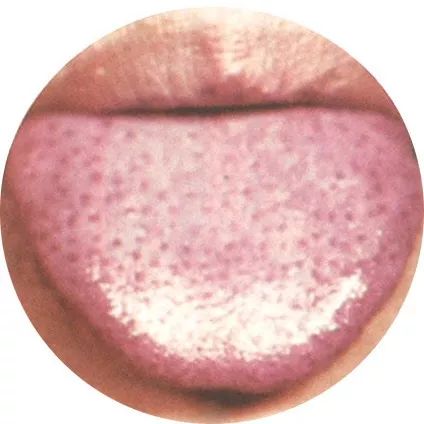 失眠|中医中的舌诊,了解吗