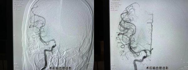 心肌梗塞|男子脑梗心梗同发命悬一线,医生心脑同治成功救回