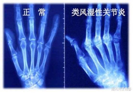 抗体|类风湿应该做哪些检查？一分钟带你了解