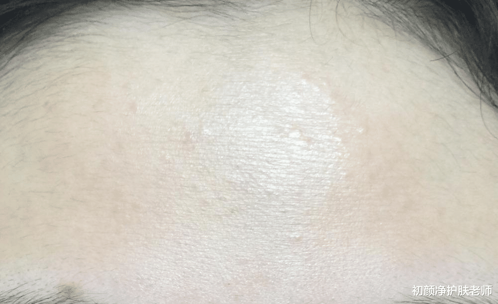 痤疮 痘痘并不代表青春,关于痘痘的那些事!