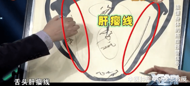 肿瘤|“只看了一眼，就说肝功有问题！” 中医通过?望?真的能判断病情？