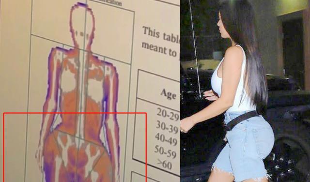 金·卡戴珊|金卡戴珊骨盆畸形暴露，比肩膀还宽！瘦到只有104斤，罕见身材