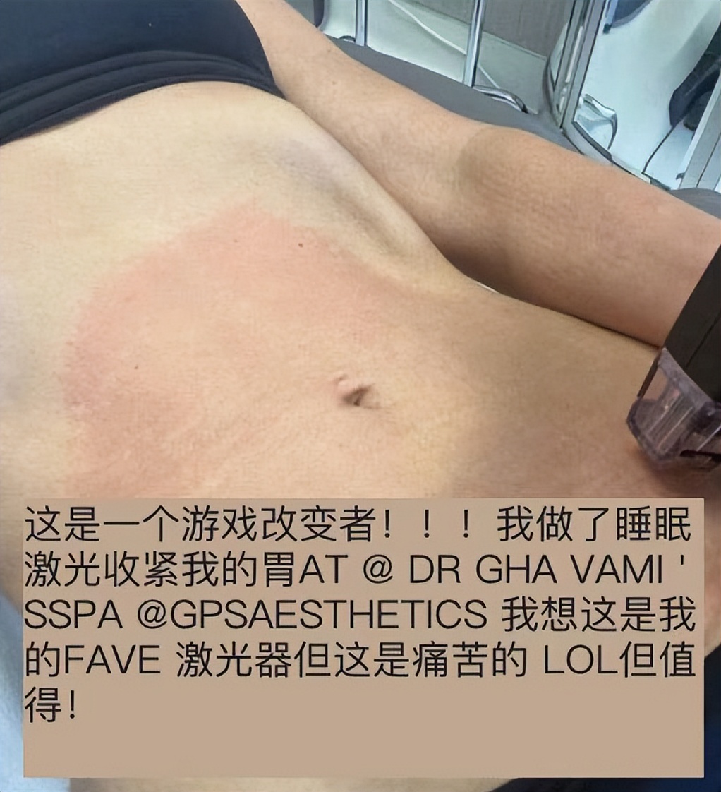 卡戴珊|“阔太”卡戴珊用激光缩胃！肚皮通红一大片，自曝脂肪集中在臀部