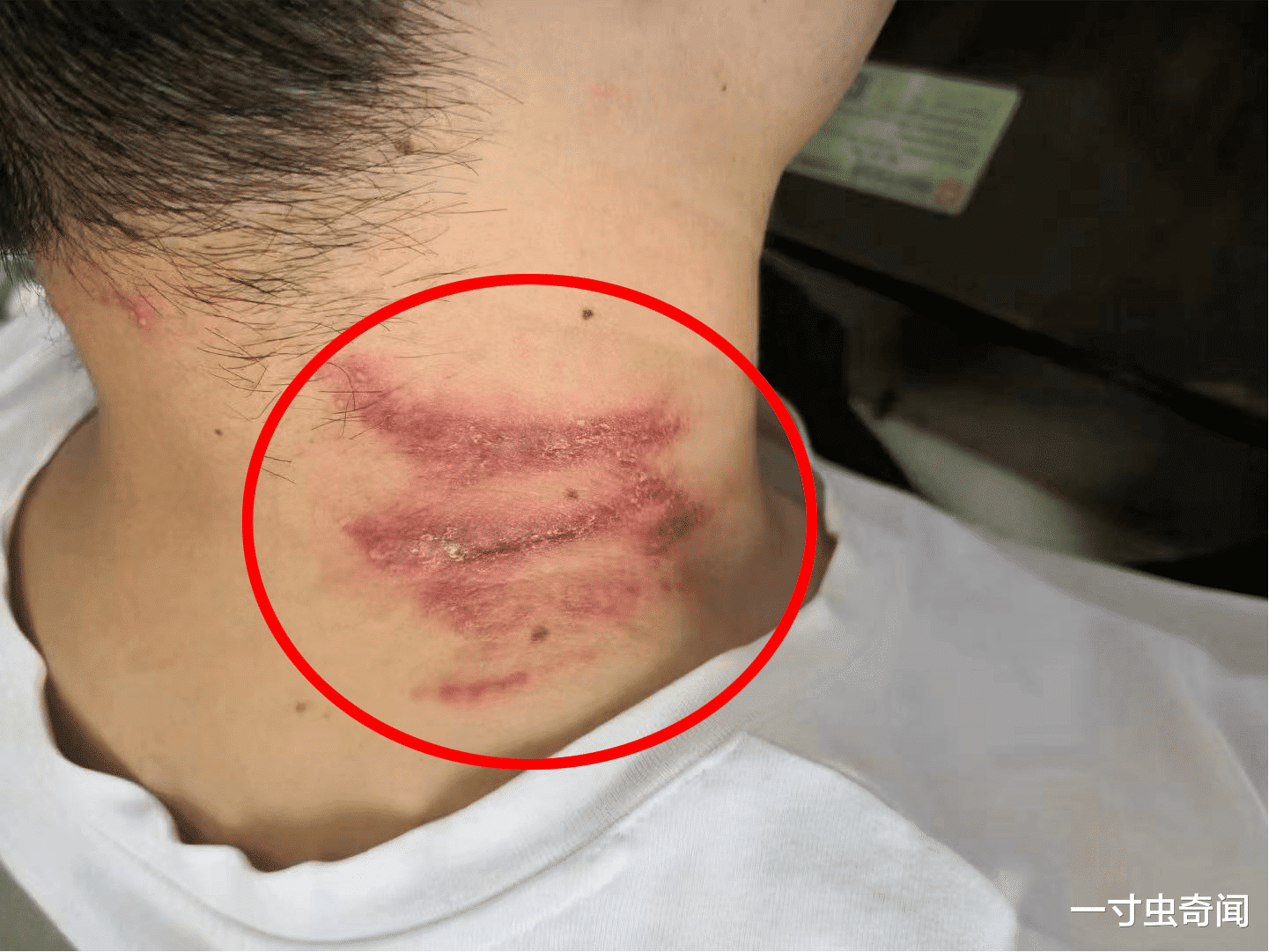 隐翅虫究竟可怕在哪?如何防范隐翅虫?其实隐翅虫也是“背锅侠”