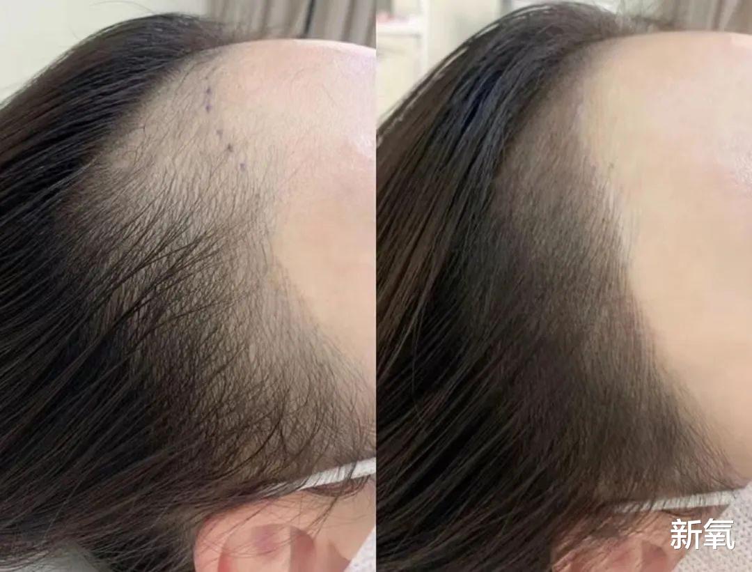 植发 秃不秃？纹发缝到底能不能撬动视觉发量？
