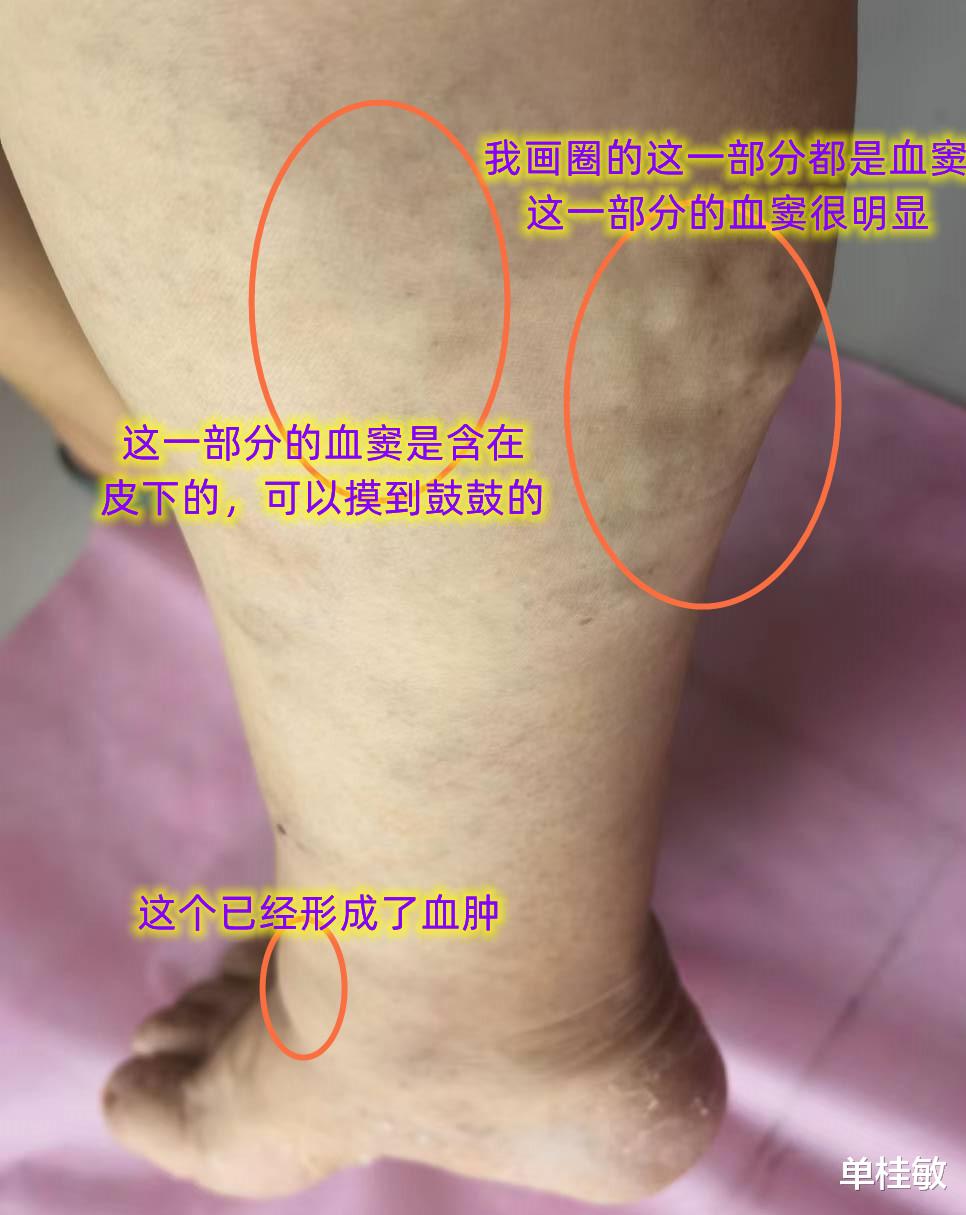 蔬菜|静脉曲张火针治疗效果非常好