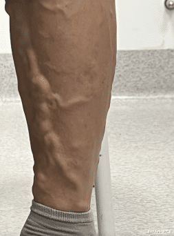 静脉曲张|炸筋腿怎么办|一线城市高管,“光鲜亮丽”背后,却因静脉曲张“苦不堪言”