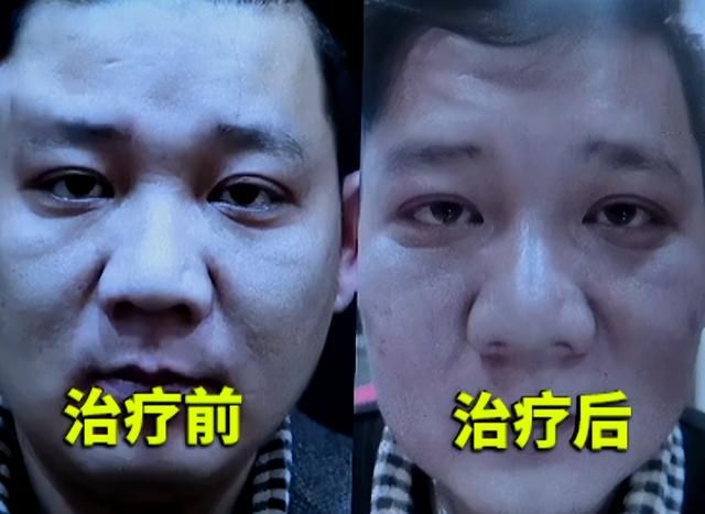 整容 39岁男子为找女友，花光母亲赔偿金整容，无钱交租后想要回整容钱